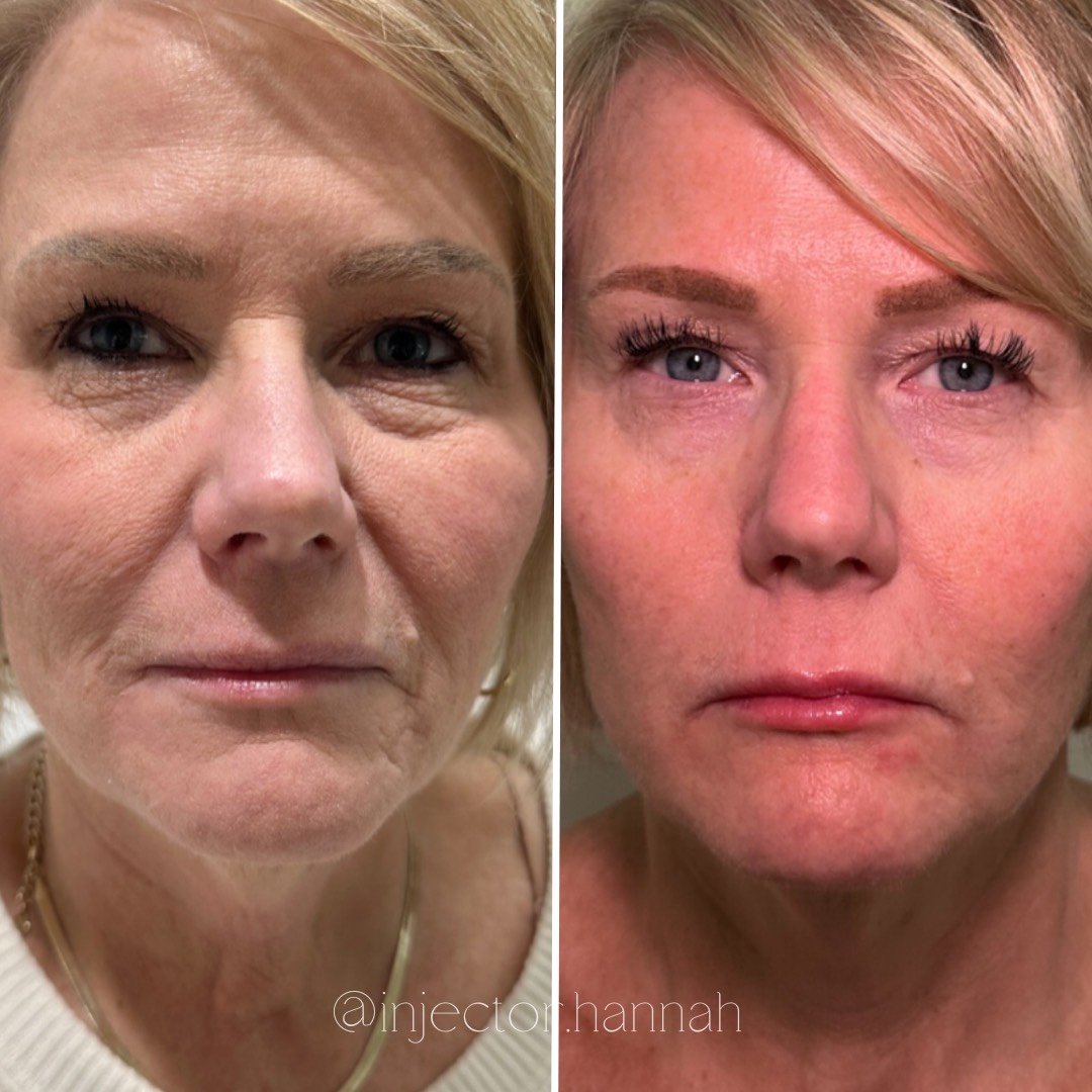 Forehead lines before/after – smoother after 2 weeks